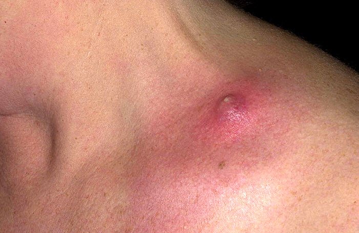 Больной прыщ под мышкой Больной прыщ под мышкой