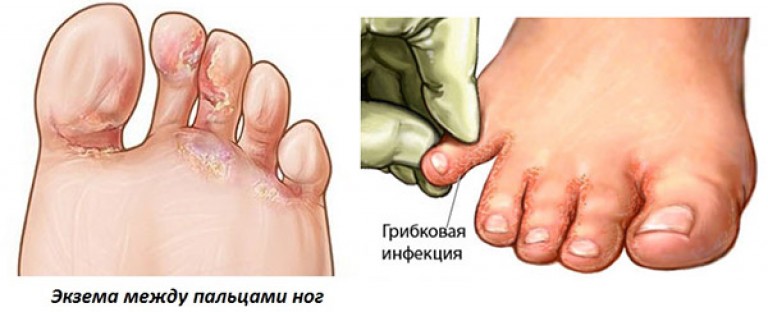 Почему между пальцами ног чешется Почему между пальцами ног чешется