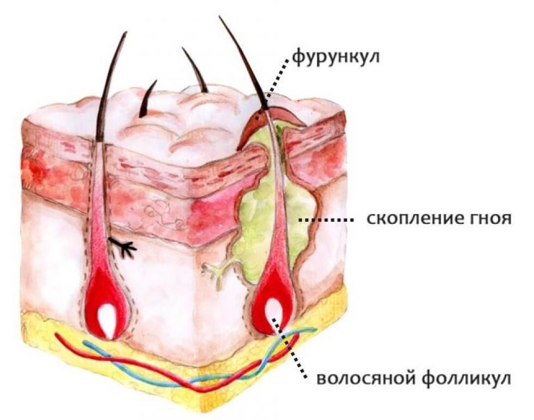 Как отличить прыщ или фурункул Как отличить прыщ или фурункул