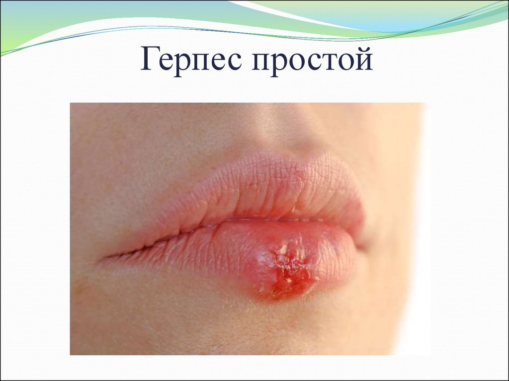 Простой герпес-что это за вирус: симптомы и лечение