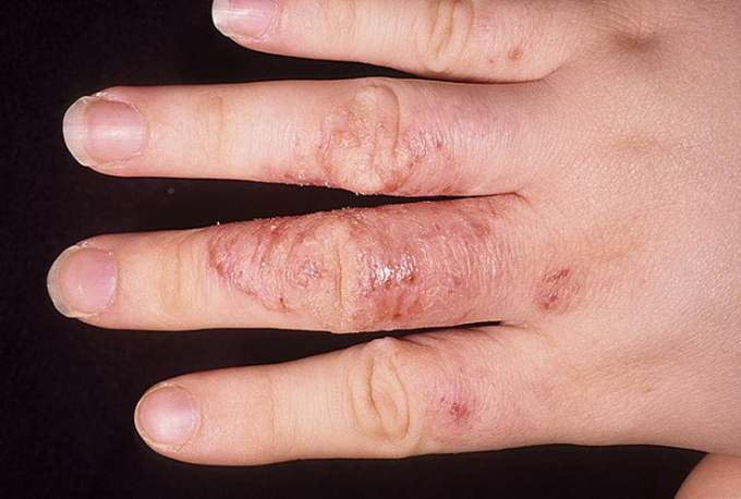 Кандидоз пальцев рук лечение thumbnail