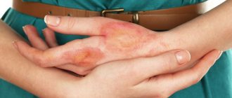 ожог уксусом