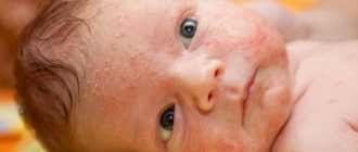 у малыша сыпь