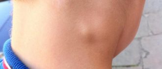 лимфоузлы при ветрянке