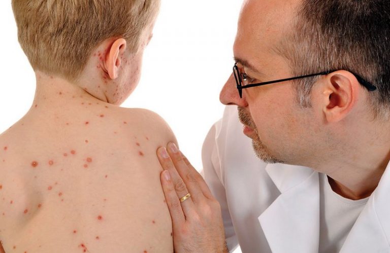 Ветрянка - сколько дней заразна после высыпания и как заразится