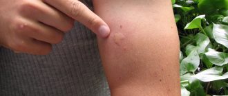 реакция организма на укус осы