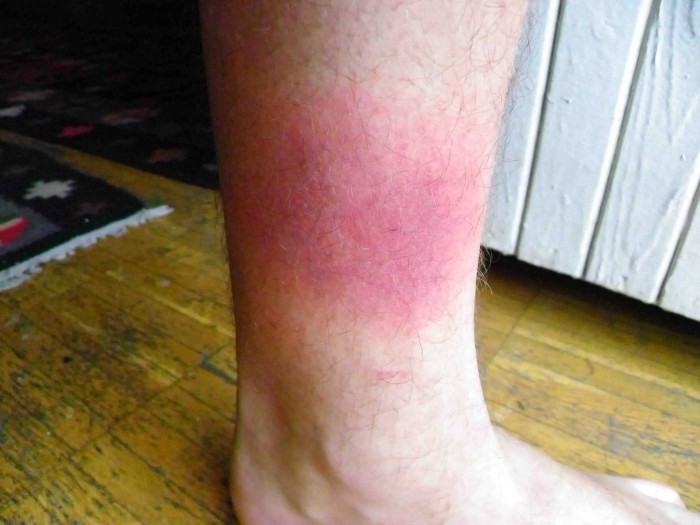 Покраснение на ноге и голени: причины красноты у мужчин и женщин