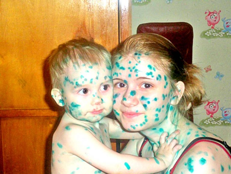 Ветрянка - сколько дней заразна после высыпания и как заразится