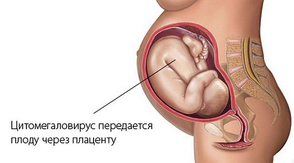 цитомегаловирус у беременных