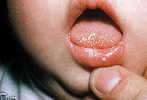 Чем лечить кандидоз во рту после приема антибиотиков thumbnail