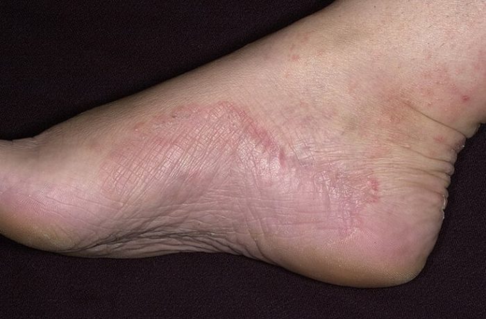 Покраснения на ногах причины фото лечение thumbnail