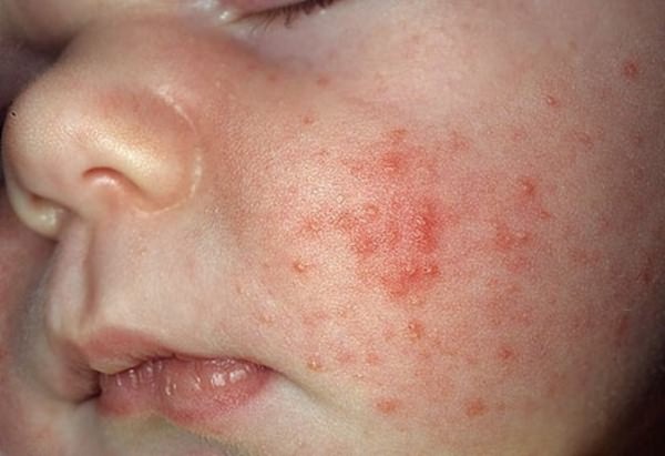 Поллиноз у детей аллергия на thumbnail