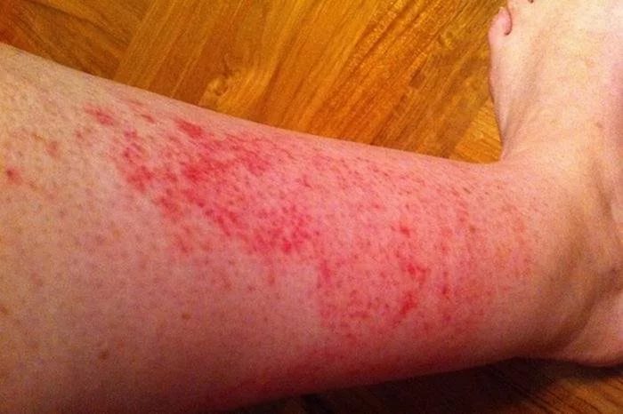 Покраснение голени ноги причины и лечение thumbnail