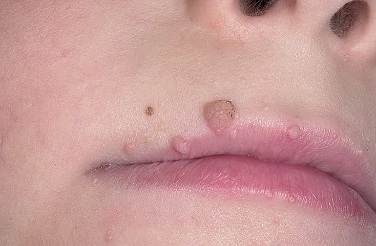 Кожные заболевания дермотологические: симптомы и лечение