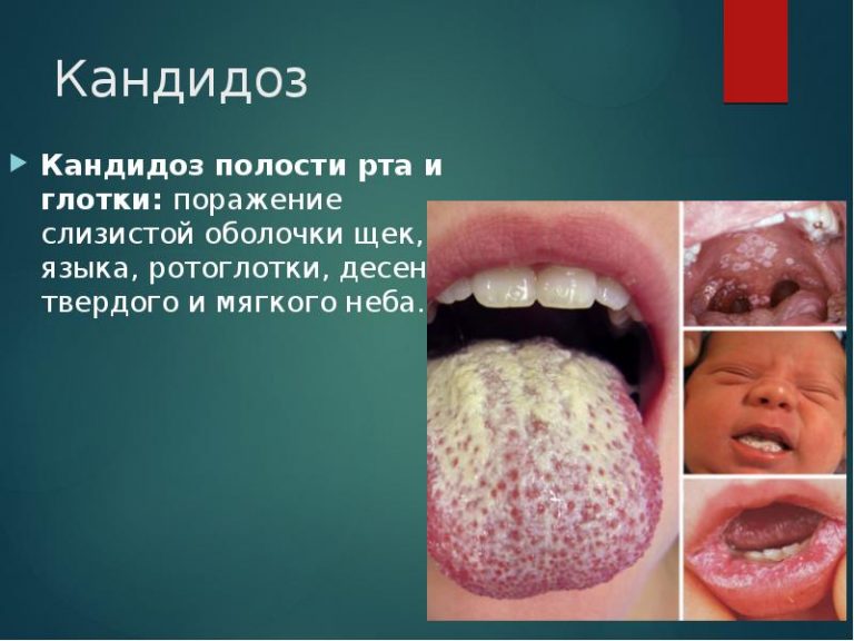Пимафуцин при кандидозе кишечника полости рта половых органов таблетки свечи крем