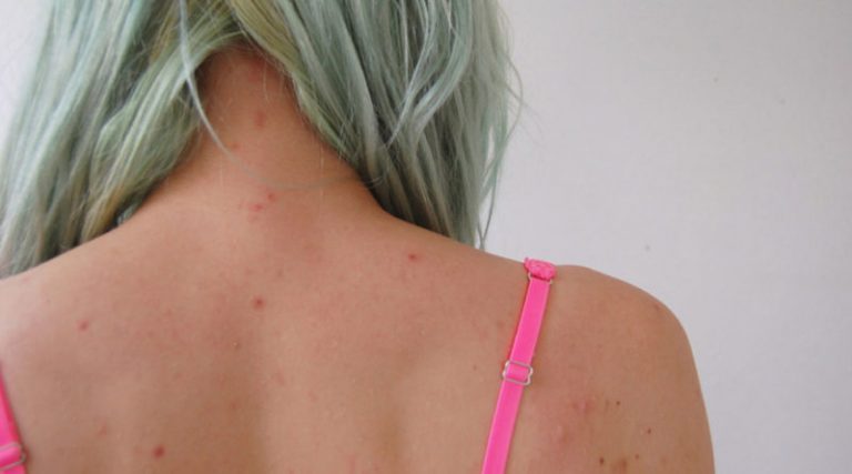 Прыщи на плечах у женщины и причины их появления на спине