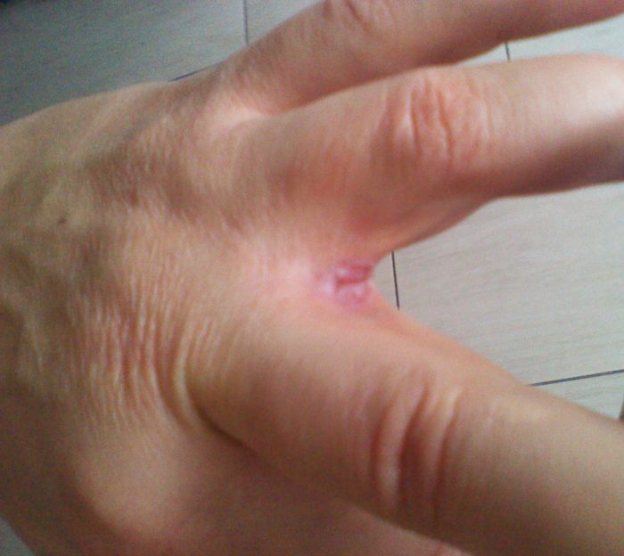 Лопается кожа между пальцами рук причины лечение thumbnail