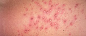 заболевание пузырчатка