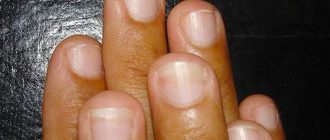 дрожжевой грибок ногтей