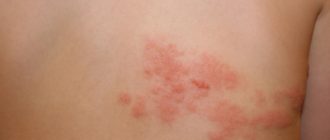 опоясывающий лишай у человека