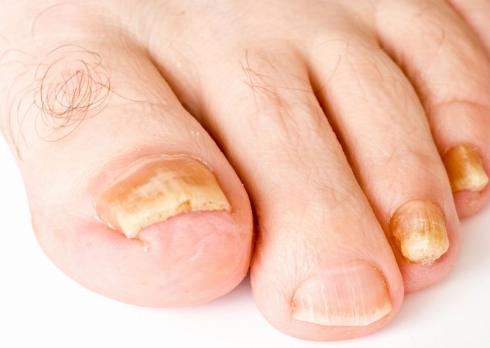 Лечение мицелия грибка ногтей - Все про грибок