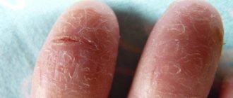 симптомы шелушения кончиков пальцев