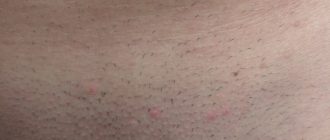 причины сыпи в паху