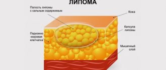 подкожный жировик