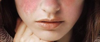 системная красная волчанка