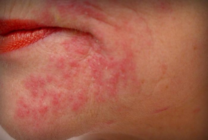 клинические проявления аллергического дерматита