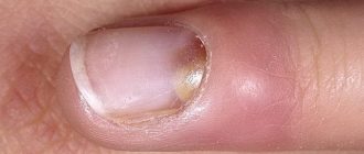 воспаление кутикулы