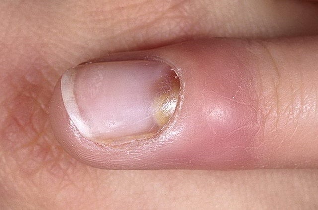 Воспаление кутикулы ногтя и пальца руки возле пластины: что послужило причиной, а также лечение мазями около больного места и иными средствами, фото