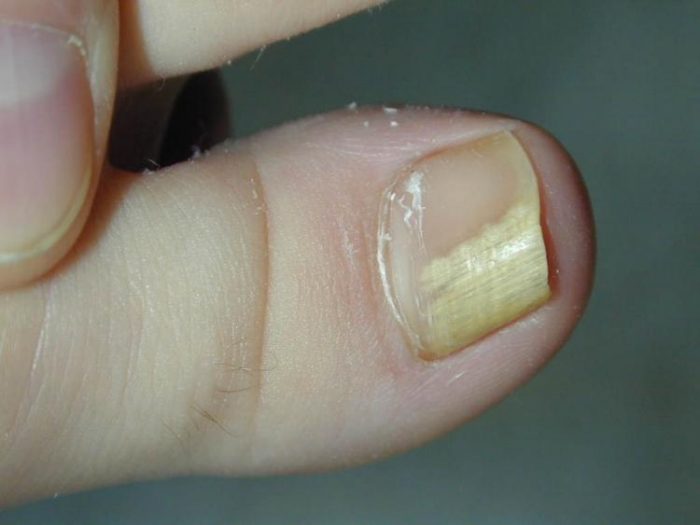 Почему слоятся ногти и как их укрепить. Отслоение ногтей на больших пальцах ног: причины и особенности лечения