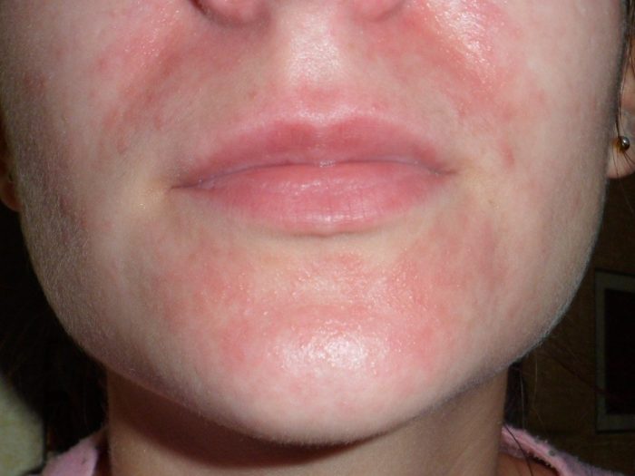 дерматит на лице