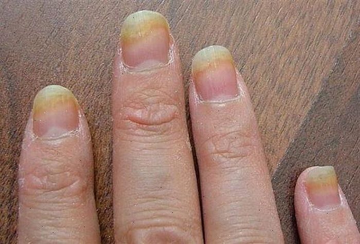 Болезни ногтей на руках и их лечение с фото
