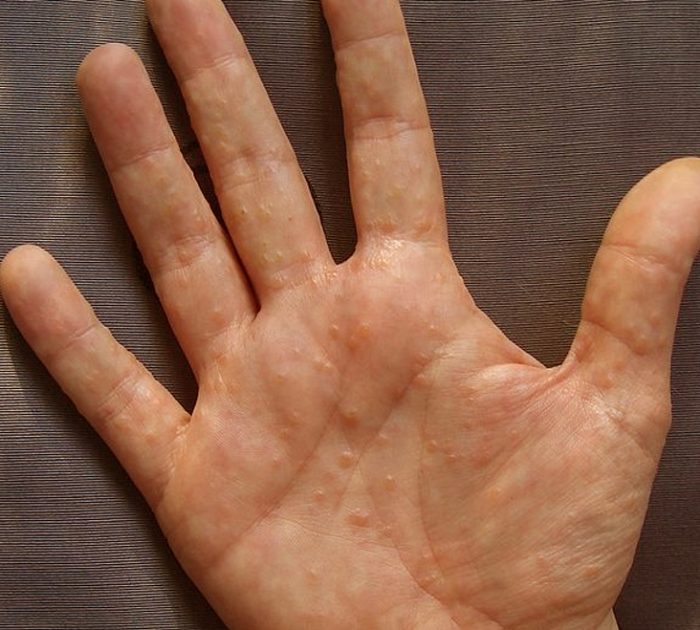Пузырьковая сыпь на пальцах рук лечение thumbnail