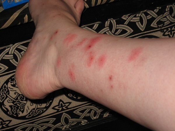 нападению кровососущих насекомых подвергаются ноги