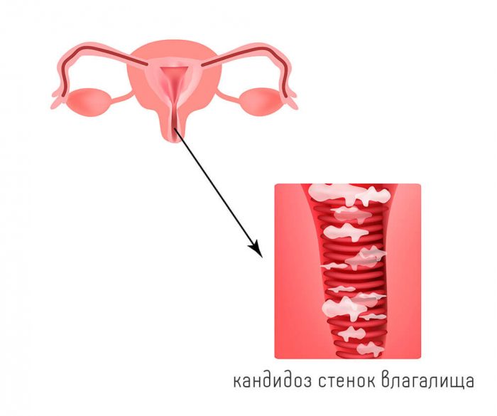 вагинальная молочница