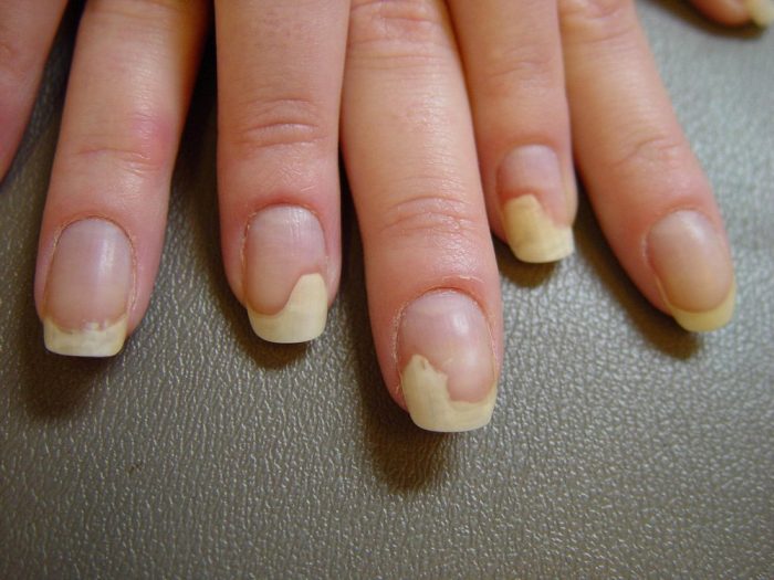 грибковые поражения ногтей