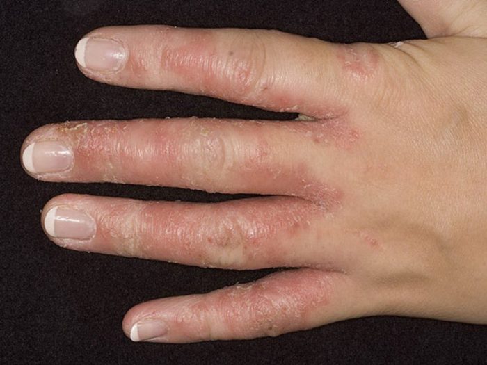 Почему трескается кожа между пальцев рук лечение thumbnail