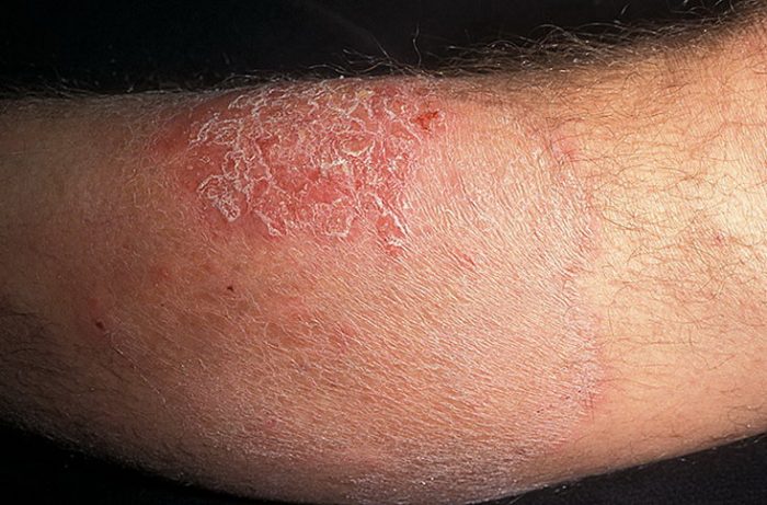 грибковая инфекция гладких кожных покровов