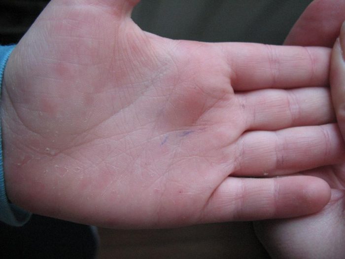 Какого витамина не хватает если шелушится кожа на пальцах рук у детей thumbnail