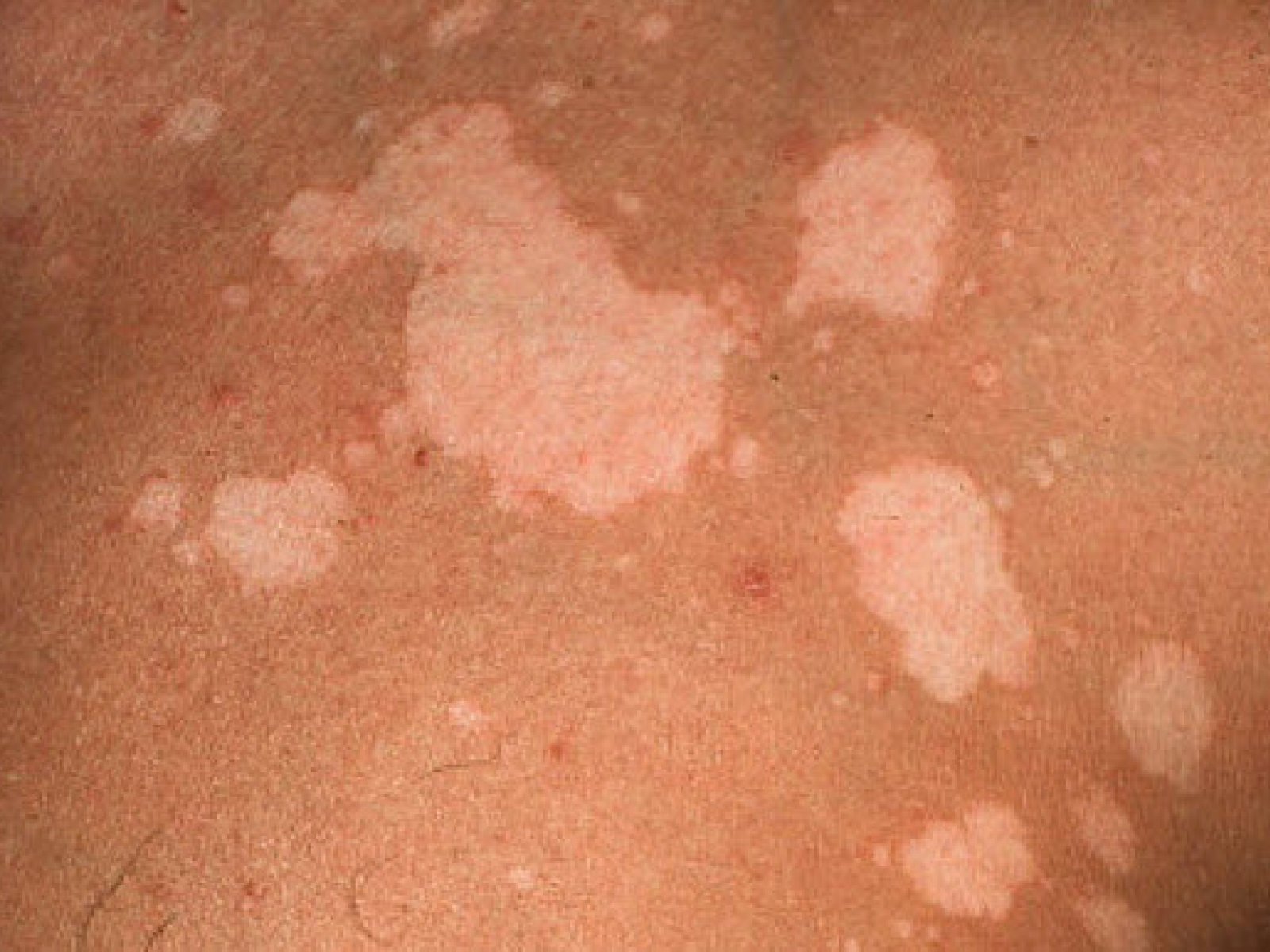 Пятна на спине белые после загара: лечение грибка