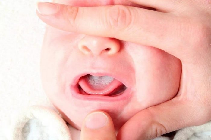кандидоз полости рта у младенцев