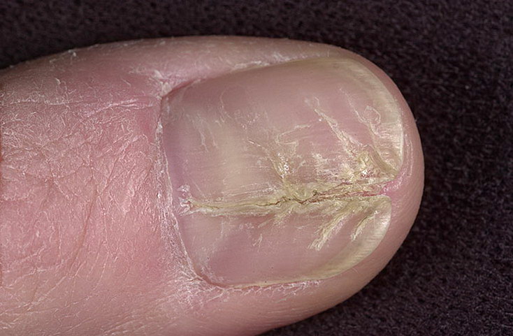 Дистрофия ногтя и ногтевой пластины большого пальца ноги