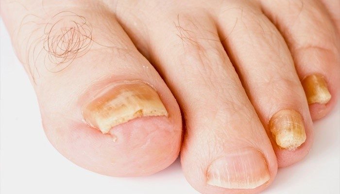 Болезни ногтей ног симптомы и лечение thumbnail