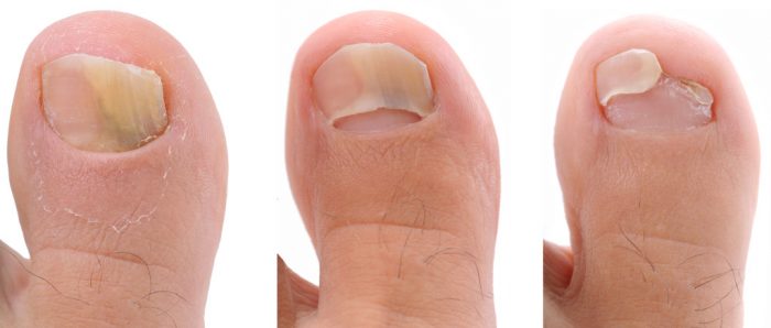 Отслоение ногтя большого пальца ноги лечение thumbnail
