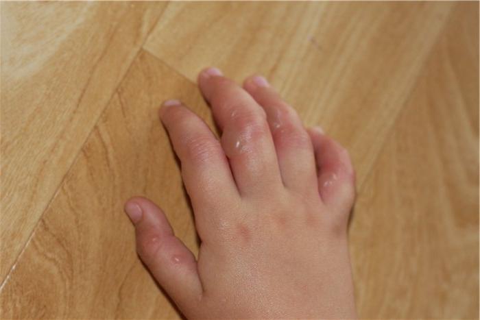 Аллергия на руках от нервов фото