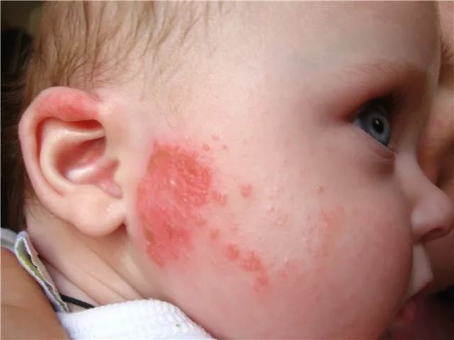 Лечение грибкового дерматита у детей thumbnail
