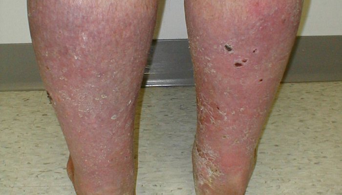 Как выглядит дерматит на ногах фото у взрослых